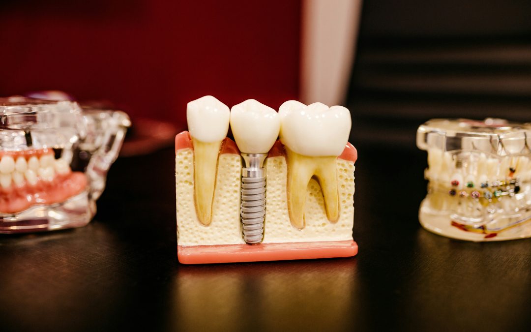 What to do when you have a hole in your tooth?