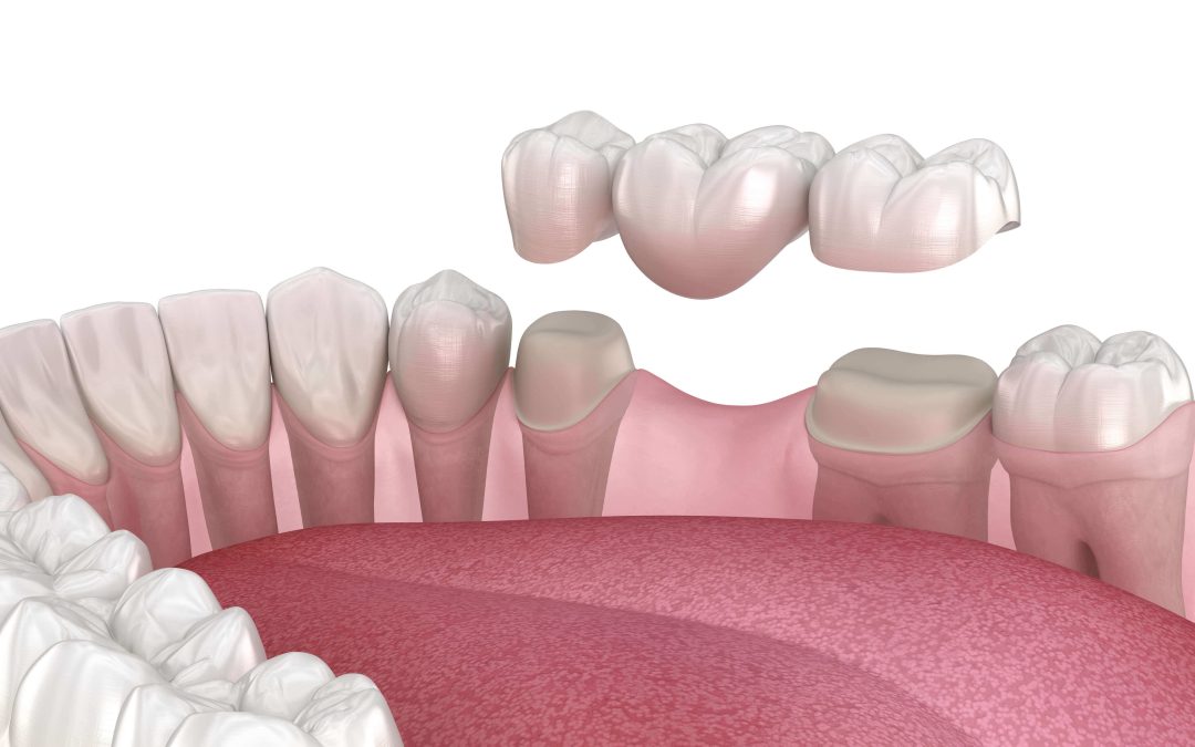 The Ultimate Guide On How To Care For Dental Crowns
