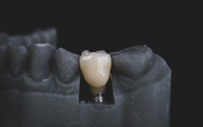 Do Missing Teeth Need to Be Replaced?
