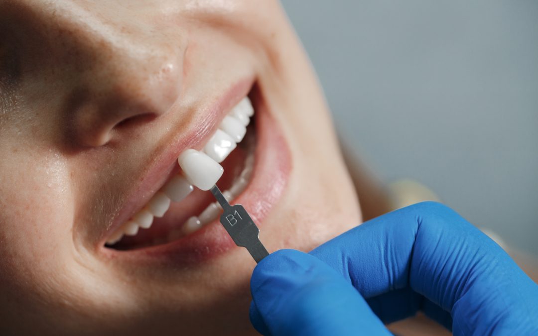 How Do Dental Crowns Restore Damaged Teeth?